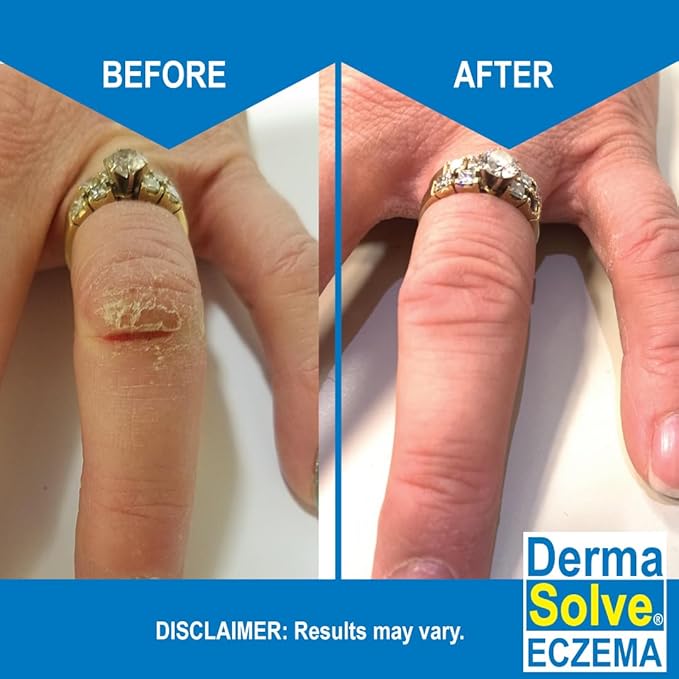 Dermasolve Eczema Relief Body Wash (2 Pack) | Protects, Moisturizes, and Repairs Skin - Kids, Babies & Adults - Steroid Free